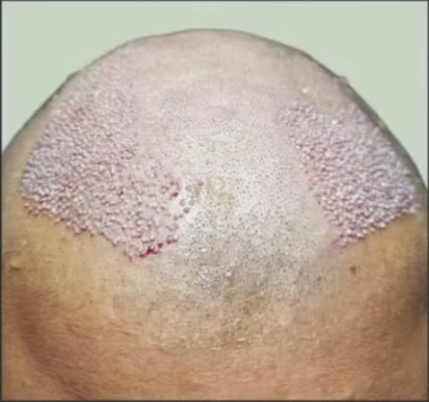 Restorasi Hairline · 1.800 Graft — sesudah