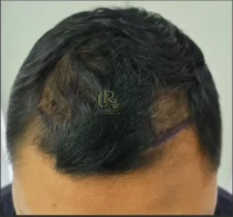 Restorasi Hairline · 1.800 Graft — sebelum