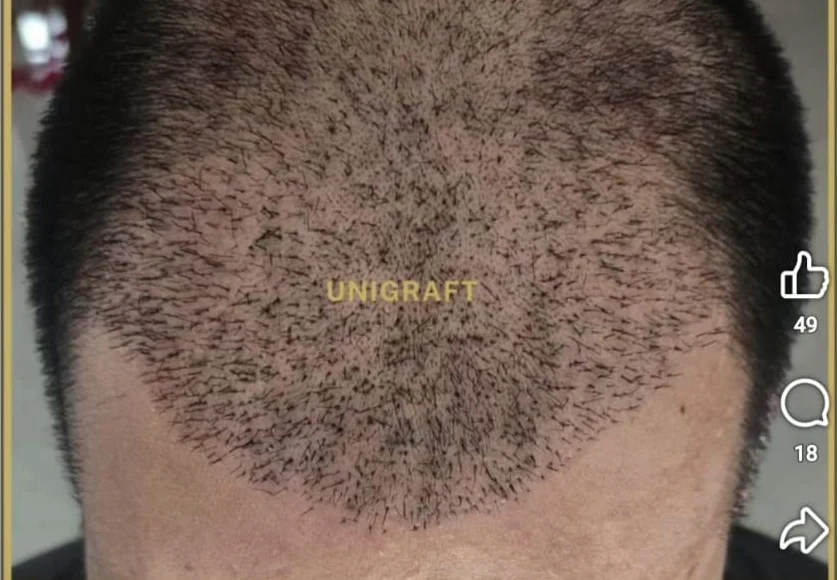13 Hari Setelah Hair Transplant — sesudah