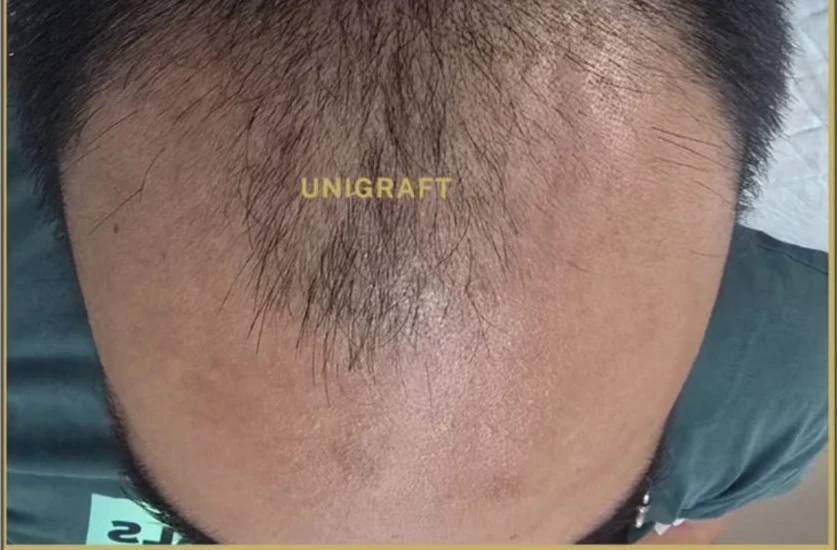 13 Hari Setelah Hair Transplant — sebelum