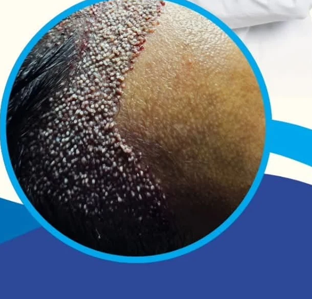 Foto jarak dekat area transplantasi rambut pasien Unigraft